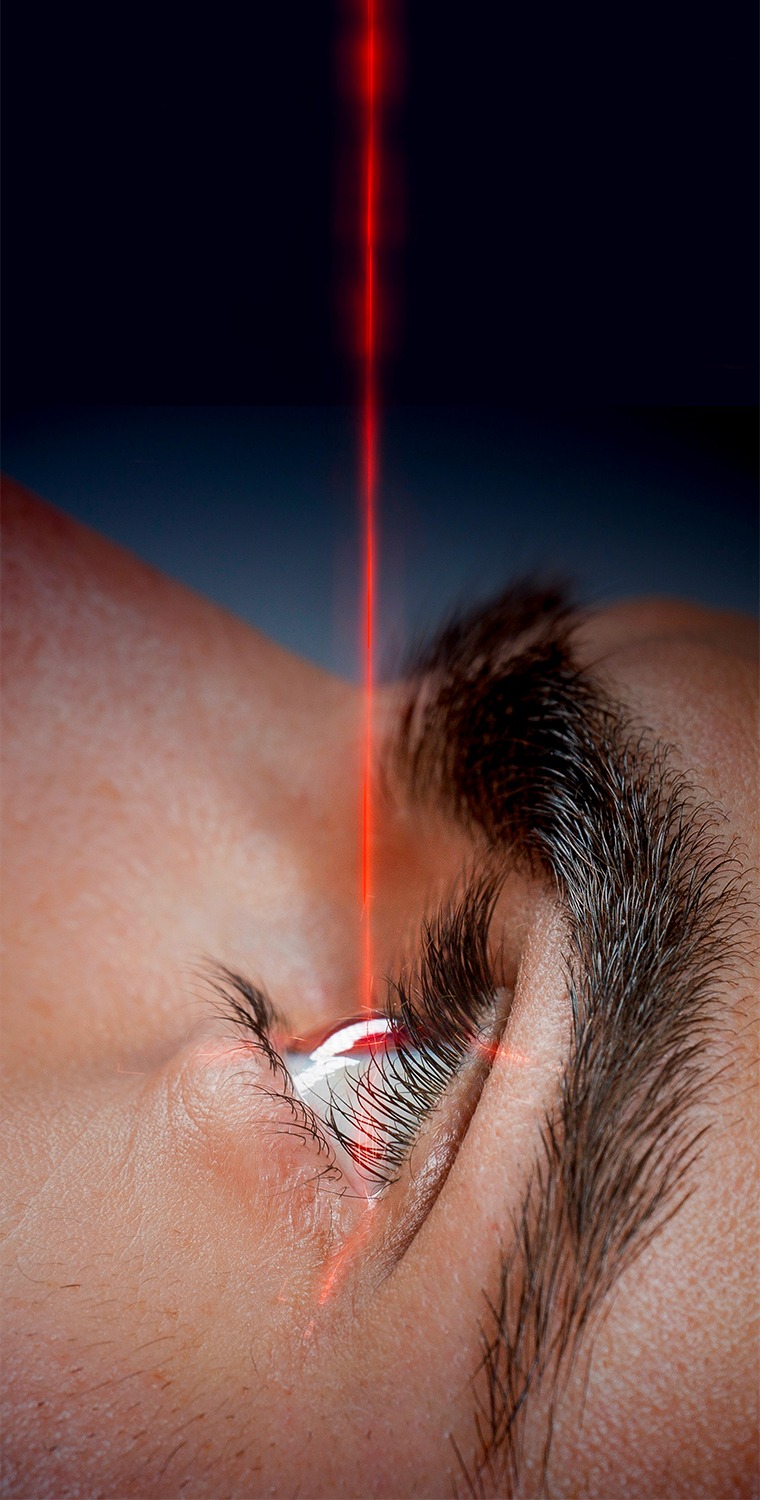 photo laser chirugie des yeux